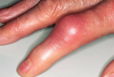 Причини за възпаление на ставите на пръстите и неговото лечение