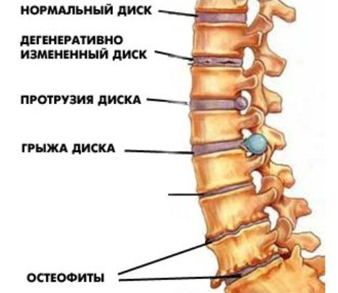 Chondroz на цервикалния гръбначен стълб и неговото лечение