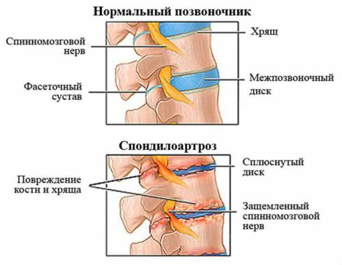 Деформиране на гръбначния стълб спондилартроза