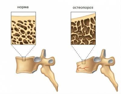 Характеристики на дифузната остеопороза и методи на лечение