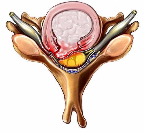 Herniated disc herniation: видове, симптоми и принципи на лечение