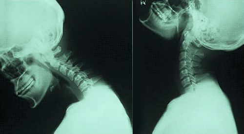 Нестабилност на цервикалния гръбначен стълб и неговото лечение