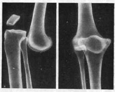 Изкълчване на коляното и неговото лечение
