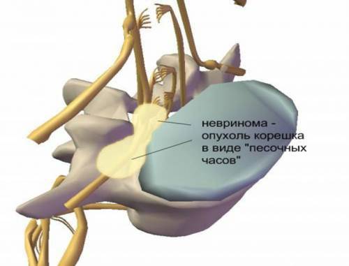 Неврином на гръбначния стълб