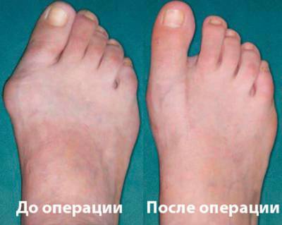 Остеоартрит на краката на ставите и неговото лечение