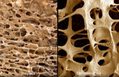 Остеопороза на коляното (колянна става)