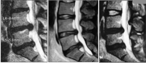 Проток на интервертебрални дискове от лумбосакралния гръбначен стълб