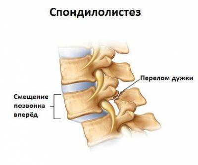 Spondylolisthesis на гръбначния стълб