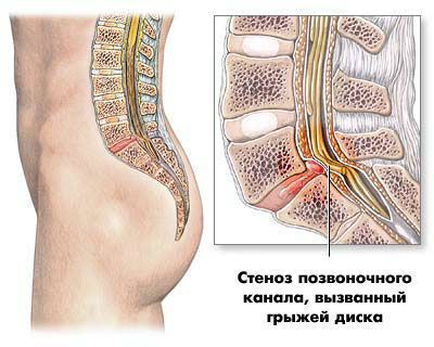 Стеноза на гръбначния канал