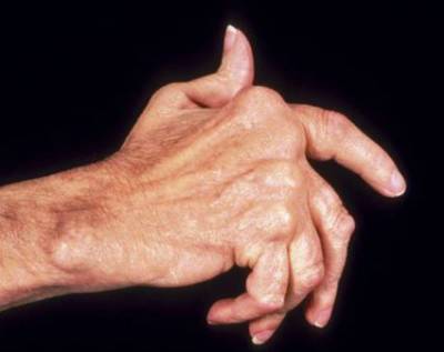 Най-често срещаните заболявания на ставите на ръцете