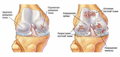 Какви са заболяванията на колянната става?