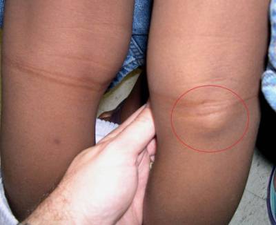 Какви са заболяванията на колянната става?