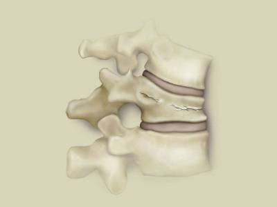 Какви са нараняванията на гръбначния стълб?