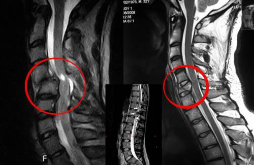 Какви са нараняванията на гръбначния стълб?