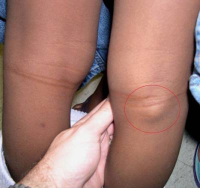 Каква е хигромата на колянната става и нейното лечение?