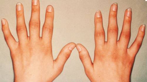 Характеристики на артрозата на ставите на пръстите и неговото лечение