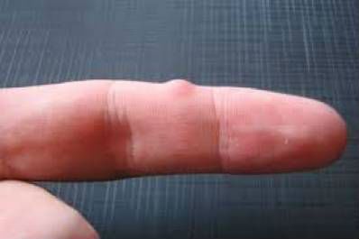 Характеристики на хигрома върху пръста