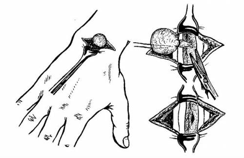 Характеристики на хигрома върху пръста