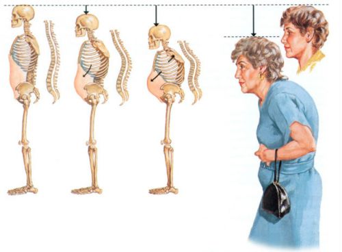 Характеристики на остеопороза 4 градуса