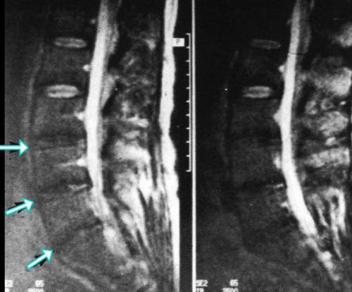 Характеристики на радикуларен синдром в лумбалния гръбначен стълб