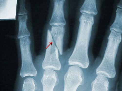 Счупвания на пръстите на краката