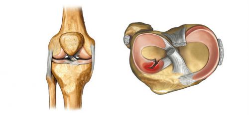 Увреждане на менискуса на колянната става