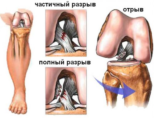 Лечение на сълзите и нараняванията на коляното