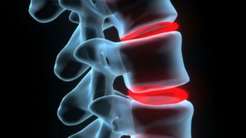 Остеоартрит на гръбнака и неговото лечение