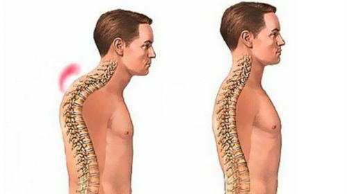 Остеохондропатия на гръбначния стълб