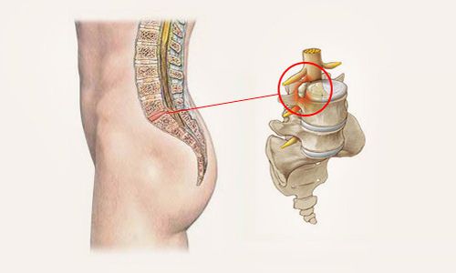 Остеохондроза на лумбалния гръбначен стълб