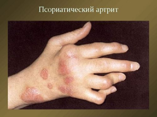 Полиартрит на ставите на пръстите и неговото лечение