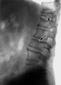 Склероза на гръбначния стълб