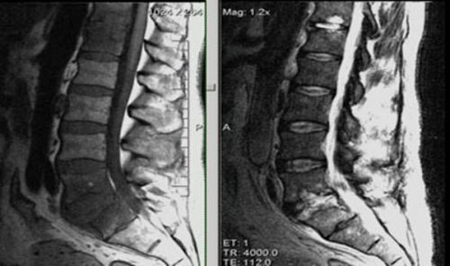 Спондилит на гръбнака и неговото лечение
