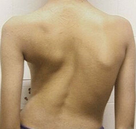 Туберкулоза на гръбначния стълб