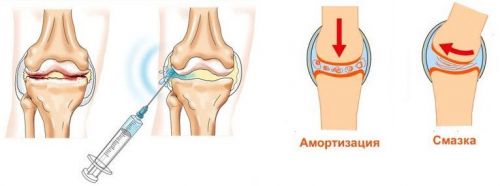 Двустранна артроза на коленните стави
