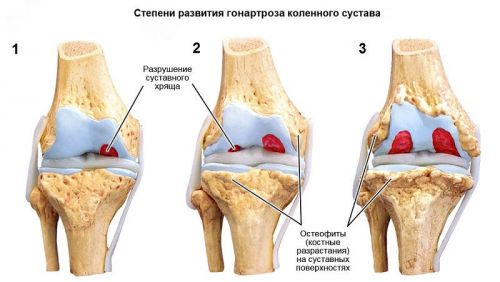 Двустранна артроза на коленните стави