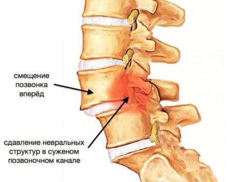 Изместване на прешлените на различни части на гръбначния стълб