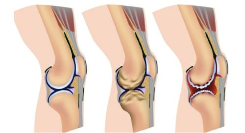 Гонартроза на колянната става от трета степен