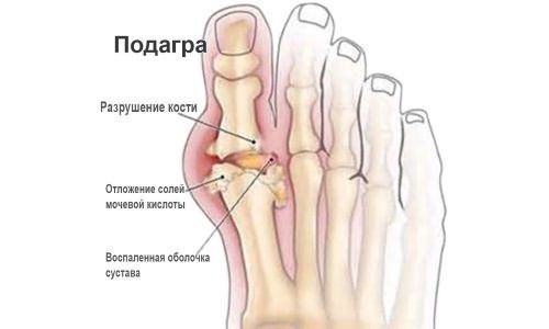 Духов артрит на краката