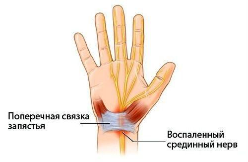 Възпаление на сухожилието на ръката