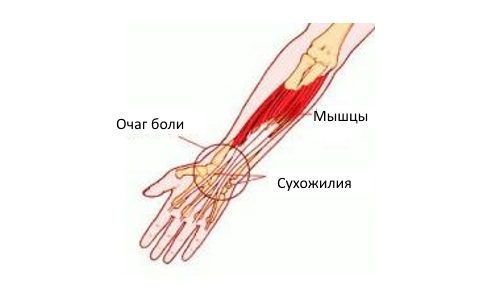 Възпаление на сухожилието на ръката