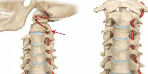 Невралгия на гръбначния стълб