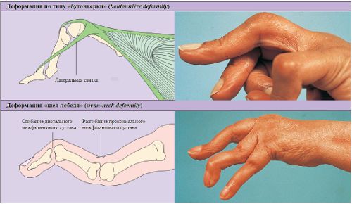 Ревматоиден артрит на пръстите на ръцете