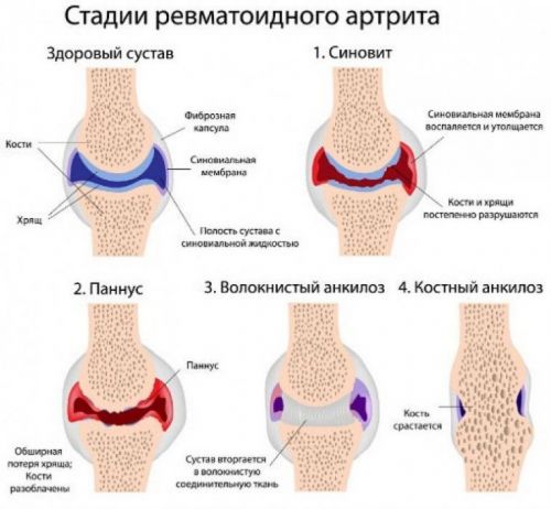 Лечение на ревматоиден артрит и облекчаване на болката в краката | Компетентно за здравето на Крем Move&Flex в България