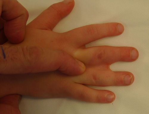 Синдром на пръстите