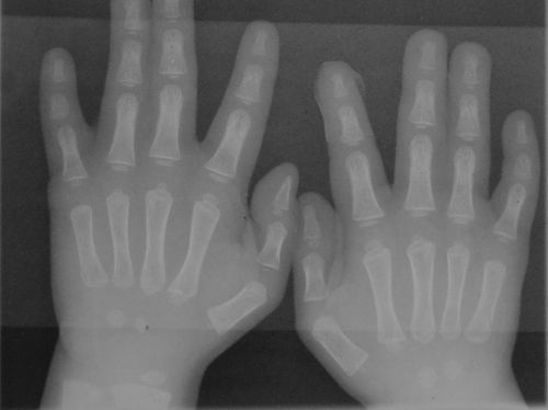 Синдром на пръстите