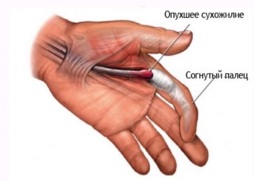 Синдромът на счупвания пръст