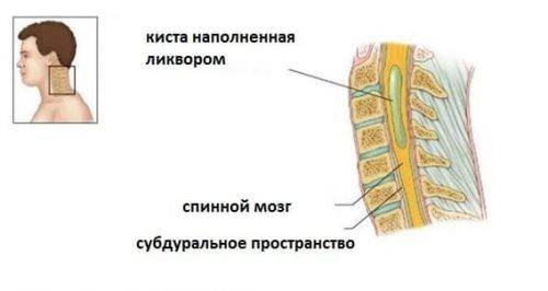 Тумор на гръбначния мозък