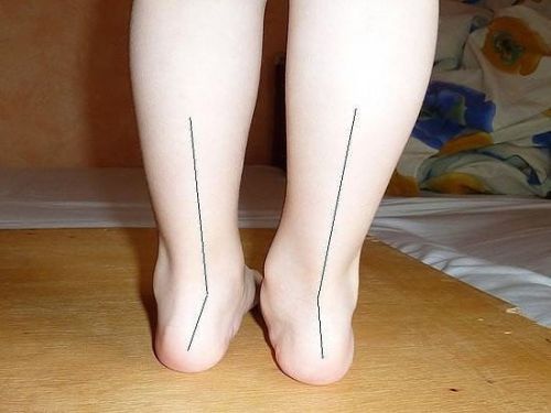 Валгус деформация на крака в детето