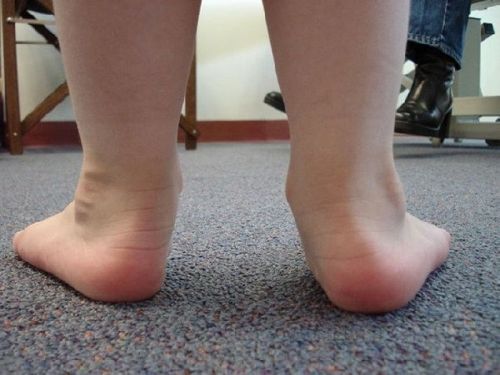 Валгус деформация на крака в детето